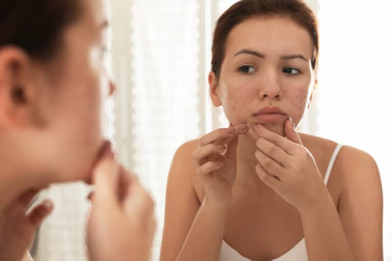 get rid of acne naturally