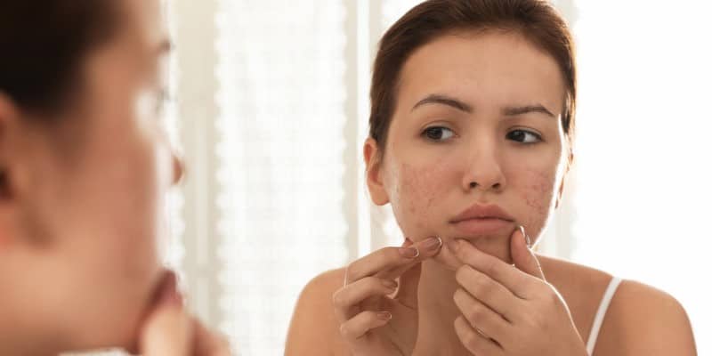 acne skin care tips